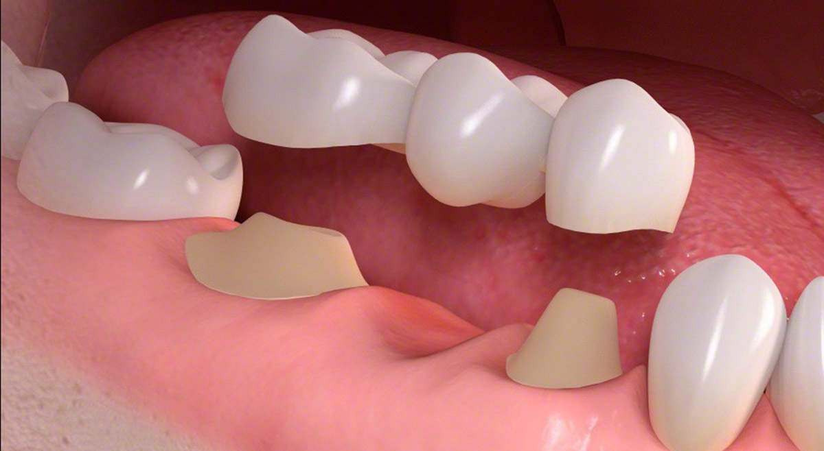 Dental Bridges